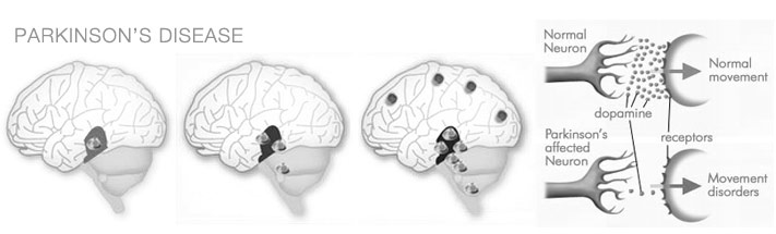 Parkinsons Stem Cell Treatment